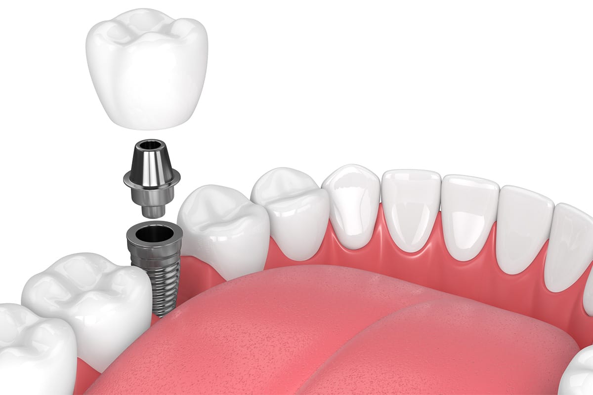 Dental Implants