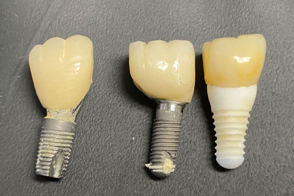 Why Your Dental Implant Fell Out Dr. Scott Froum Midtown NYC