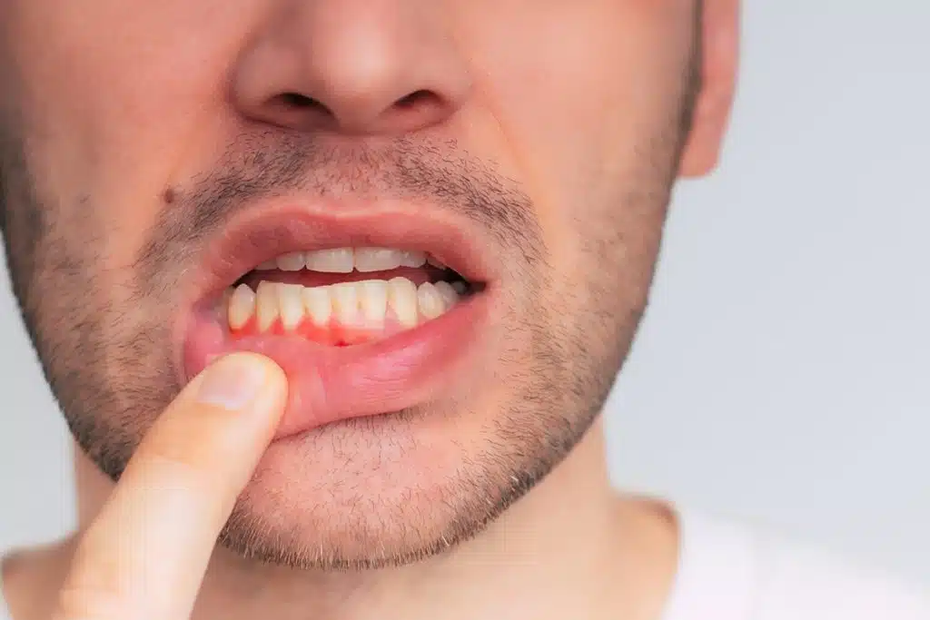 How to Prevent Gum Disease